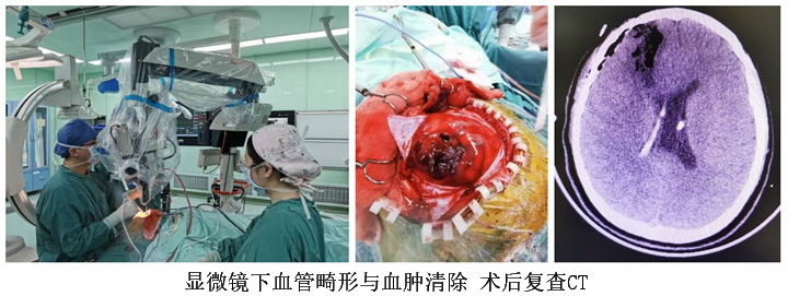 脊髓血管畸形复合手术图片